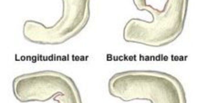 Meniscus Injuries image