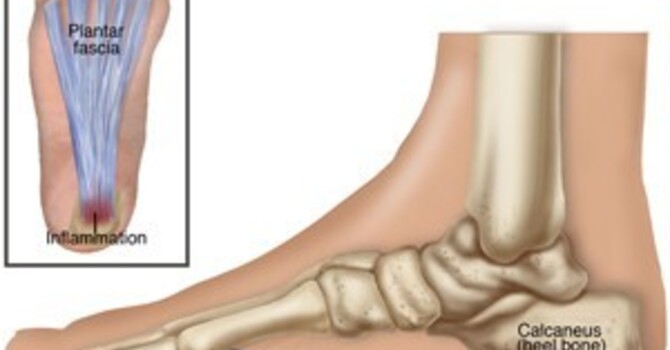 Plantar Fasciitis