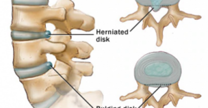 Bulging/Herniated Disc