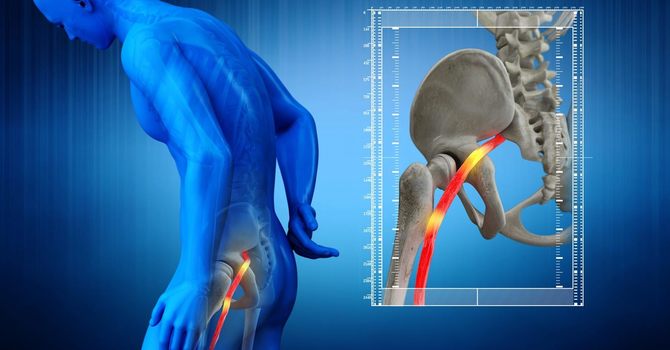 Finding Relief: A Guide to Understanding and Treating Sciatica Pain