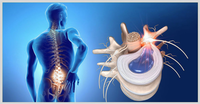 The Best Evidence-Based Treatments for Herniated Discs in South Jersey