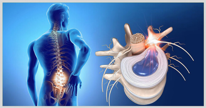 The Best Evidence-Based Treatments for Herniated Discs in South Jersey image