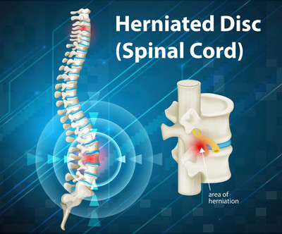 Pain Relief Without Surgery (5)