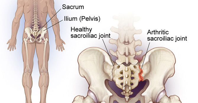 SI Joint Pain vs. Low Back Pain: How Are They Different?