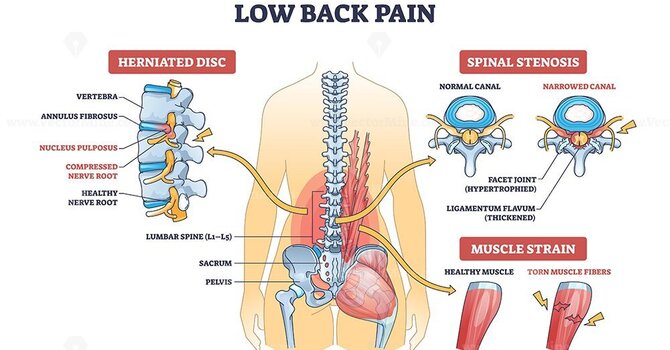 Disc-Related Back Pain vs. Muscle Pain: Can You Tell the Difference?