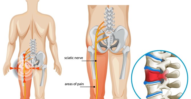 What Is Sciatica — and What Does the Sciatic Nerve Actually Do?