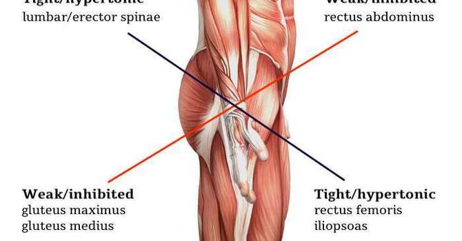 Lower Crossed Syndrome: What Is It Really Describing?