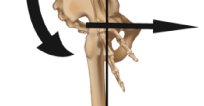 What Is a Sway-Back Posture — and Does It Automatically Cause Pain?